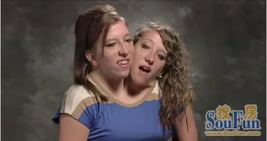 据悉,这对连体双胞胎姐妹有两个头颅,两个大脑和两根在骨盆处融合牡 